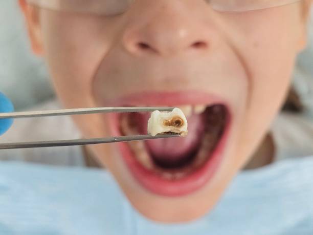 Best Emergency Dental Care for Broken or Chipped Teeth in Park Forest, IL