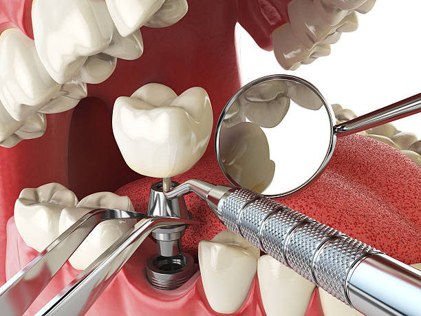Best Emergency Tooth Extraction in Park Forest, IL